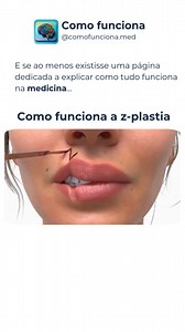 151K views · 3.8K reactions | Como funciona a Z-plastia? 啕✂️ A...