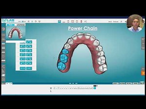 Webinar Clips: Power Chain Technique with Aligners