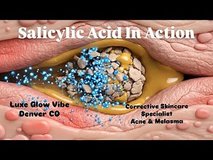 What Actually Happens Inside a Clogged Pore Salicylic Acid in Action Acne Under the Skin Explained