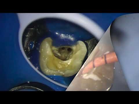 Bioceramic sealer in confluent root canals- The magic of Ceraseal