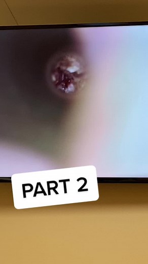 #swim #swimmersear #theworst #sogross #nastyear #part2#scope#earblisters #earcleaning #earcyst