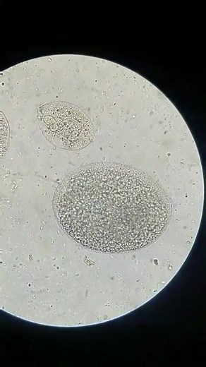 76K views · 1K reactions | Fecal sample  #lablife #MedicalLabTechnician #diagnosis | Lab life | Facebook