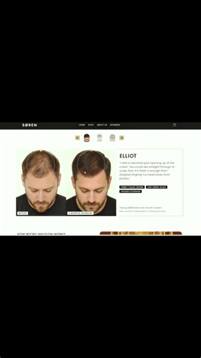 Before Buying Soren Hair Regrowth Watch This #shorts