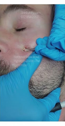 Removal Sebaceous hyperplasia from face using LamProbe