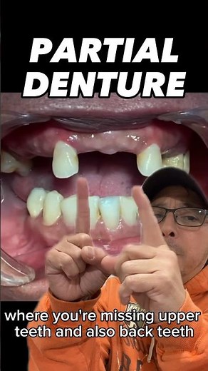 A FAST and EASY Way to Replace Missing Teeth (Partial Denture) | View Mobile Dental #shorts