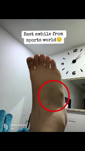 Understanding Jones Fracture and Recovery Process