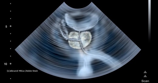 Transrektaler Ultraschall – so funktioniert TRUS