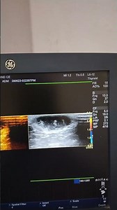 Subcutaneous cyst. Ultrasound