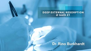 Clinical cases performed by Dr. Rino Burkhardt: Deep external resorption (tooth 21). Watch the video and discover all the steps involved in the surgical treatment: #MinimallyInvasivePeriodontalSurgery #MicrosurgicalGrafting #RegenerativeMicrosurgery | SwissPerio