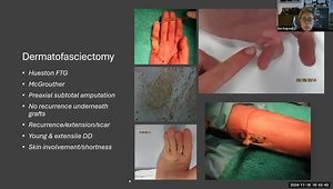 Dupuytren Surgery: What, Why and When?