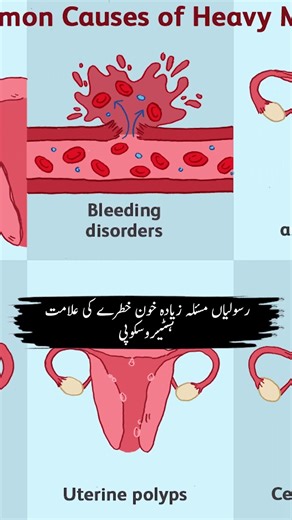 Zyada Bleeding Ko Ignore Na Karein