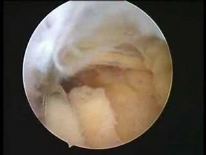 Arthroscopic Ostophyte Bone Excision In Elbow • Video • MEDtube.net