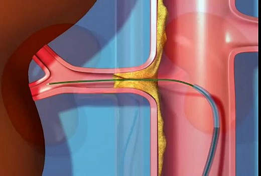 Renal Stent Procedure Animation