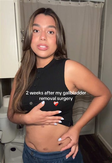 2 Weeks Post Gallbladder Removal Surgery Update
