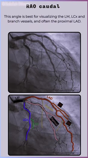 Abdallah Othman on Instagram: "A quick Guide to Standard Coronary Angiographic Views❣️ #Cardiology #Angiography #CathLab #MedicalEducation #CardioTwitter #HeartDisease #InterventionalCardiology Source: intuitivecardiology.notion.site/angiography"