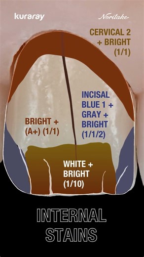 Aged Tooth with CERABIEN MiLai