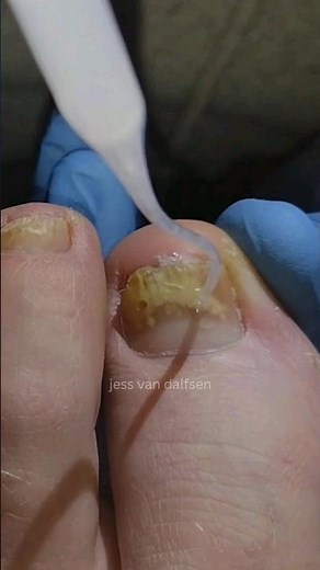 Fenestration 😳 fungal nail treatment | Foot Health Practitioner