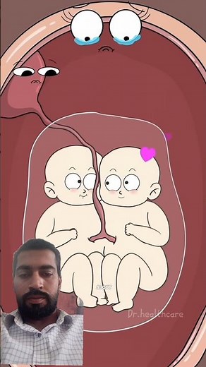 Conjoined Twins Explained 👶💔 | What Happens When an Embbryo Splits Too Late? 175