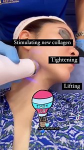SECRET RF MICRONEEDLING