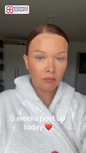 5.2K views · 87 reactions | 5 weeks post op Deep Plane Face and Neck Lift with Dr. Soner. So happy with my healinn journey starting to feel a little human now dr soner you really are the face god!!! Just click the link in bio and let your transformation begin with Booking Surgery. Whataspp: https://wa.me/905396769475 #facelift #necklift #plasticsurgery #bookingsurgery | Booking Surgery | Facebook