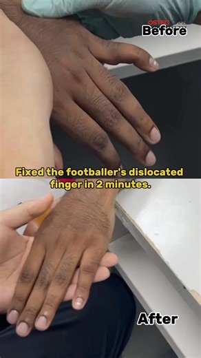 He dislocated his finger while playing as a goalkeeper after being hit by the football, but Sifu William was able to fix it in just a short session.#kotadamansara #erikleong #梁氏祖传跌打驳骨医馆 #跌打 #TabibTulang #officeworker #officepain #TraditionalBoneSetting #malaysia #video #trending #viral #reels #instagood #instagramnails #pj #kl #cheras #ss2 #rawang #kepong #backpain #fyp #OfficeLife | Osteocare