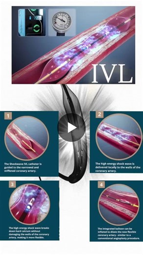 💥 How IVL shockwaves break calcium in coronary arteries? In IVL (Intravascular Lithotripsy), a “pulse” is one single burst of acoustic shockwave energy delivered by the catheter to the calcified… | Sana Parveen