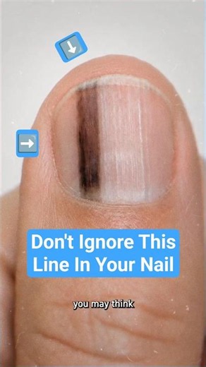 Don't Ignore This Line in Your Nail