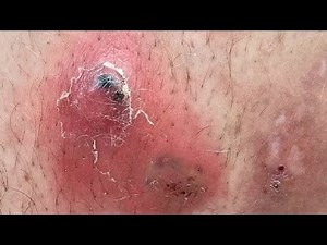 HOW TO GET RID OF INGROWN HAIRS RESULTS