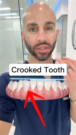 Why Straightening Crooked Teeth With Invisalign Can Reveal New Gaps…