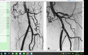三千四百元的教科书 Abrams' Angiography-6 下肢动脉造影-2 20180728-202122449