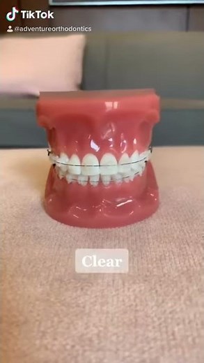 Types of Braces | Dr Bar The Braces Doc