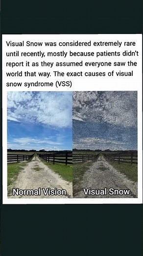 Normal Vision vs Visual Snow syndrome