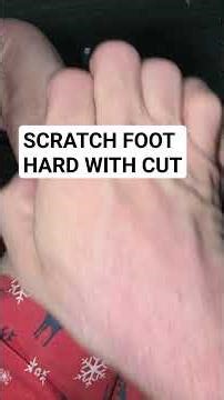 SCRATCHING HARD MY Foot SCAB (WARNING: BLOODY)