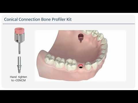 Keystone Conical CC Bone Profiler Kit Instructions