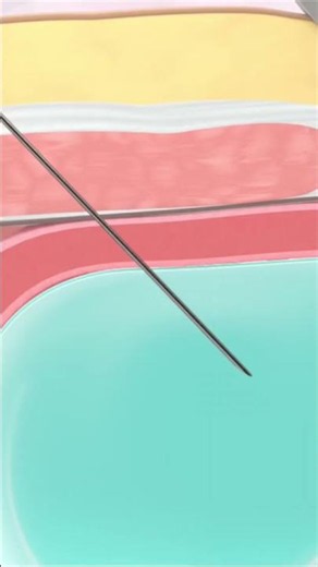 🩺 What is Amniocentesis? #Amniocentesis #PregnancyCare #PrenatalTesting