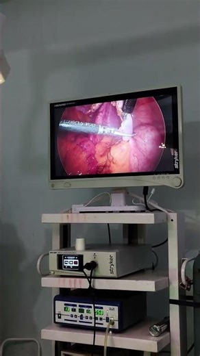 Laparoscopic appendix operation ka live surgery video #AppendixOperation #AppendixSurgery #appendix