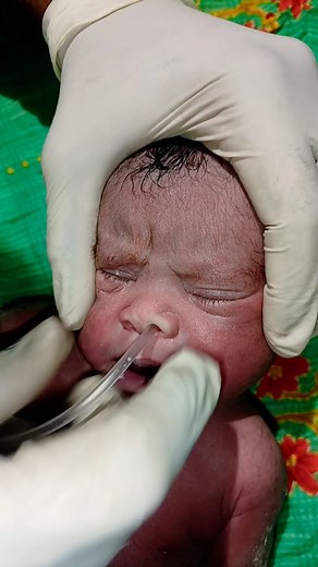 1M views · 11K reactions | Newborn baby after birth #shortvideo #medical #newborn #nursing #trending #baby #motivation #viralreelschallenge2025viralreelschallengejaiviralreelschallengeviralreelschallenge #fbyシvideo #trending | Nisha Nursing NICU Work | Facebook