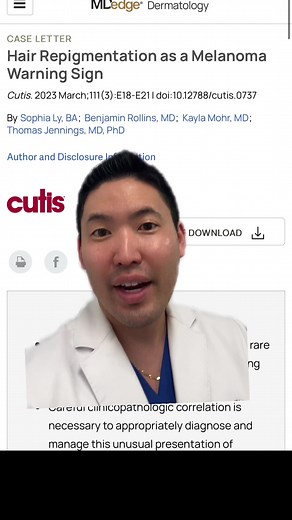 Scalp Moles and Melanoma: Importance of Hair Pigmentation