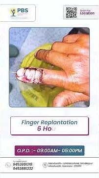 Finger Injury After Accident? Emergency Treatment Explained! Cut, Fracture, Damage Don’t ignore it!