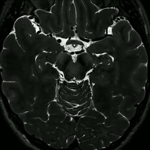 T2 Axial Cranial Nerves (from Imaging Anatomy of the Human Brain)