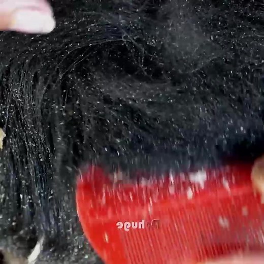 Dandruff Removal By Hand With Comb!! - Satisfying and picking psoriasis scratched #202 Part 8 | Help remove ticks