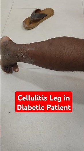 Cellulitis Leg in Diabetic Patient...Dr Sai Chandra MBBS DNB Ortho... What's App 9573517107
