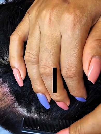 Dandruff Combing BIG FLAKES #DandruffScratching #ItchyDryScalp #HugeFlakes #Dandruff #dandrufftreatment #satisfying #dandruffremoval Disclaimer: Videos do not show original Dandruff, they are used for education purpose. Thank You,,,, | The Filmy