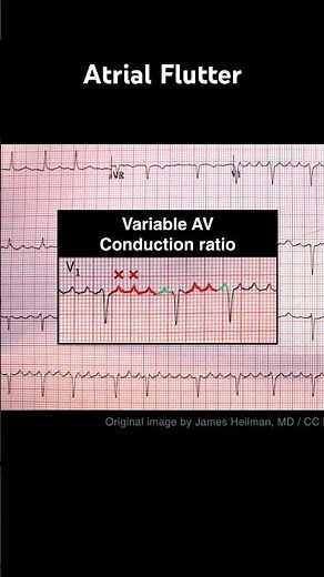 Atrial Flutter ECG: Variable AV conduction ratio