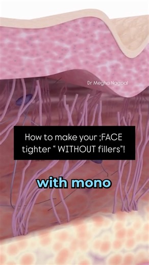 Megha Nagpal on Instagram: "What are mono threads? Mono Threads are fine threads made of an absorbable material called polydioxanone. They are inserted into the subdermal layer of the skin in a mesh-like pattern which results in an increase in collagen production in the skin. . . Amazing Benifits like - . PDO Mono Threads have a multitude of benefits including; Skin tightening & lifting. Increasing collagen production. Lifted cheeks. A more defined jawline. Facial contour. Softer smile lines. Li