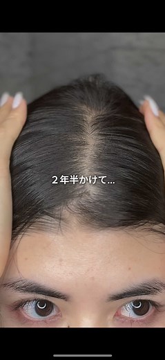 AGA治療の成果と美容師の褒め言葉