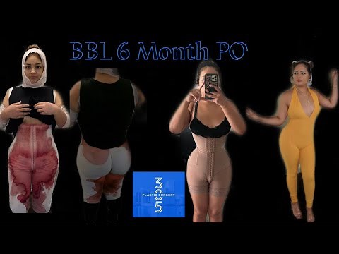 BBL | 6 Month BBL Update | 305 Plastic Surgery | BBL Regrets | Results, Doctor, Post op care