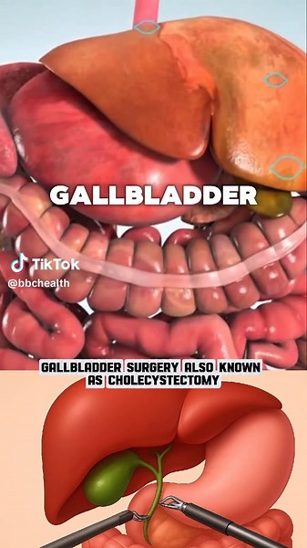 Gallbladder surgery also known as cholecystectomy....... #gallbladder #gallbladderremoved #gallbladdersurgery #surgery #healthylifestyle
