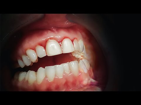 Get Rid Of Gum Disease FOR GOOD!