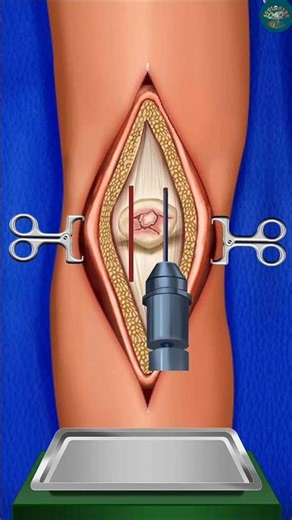 Relaxing ASMR Leg Surgery Simulation 😱 | Satisfying Medical & Treatment Sounds #asmr #shorts #care